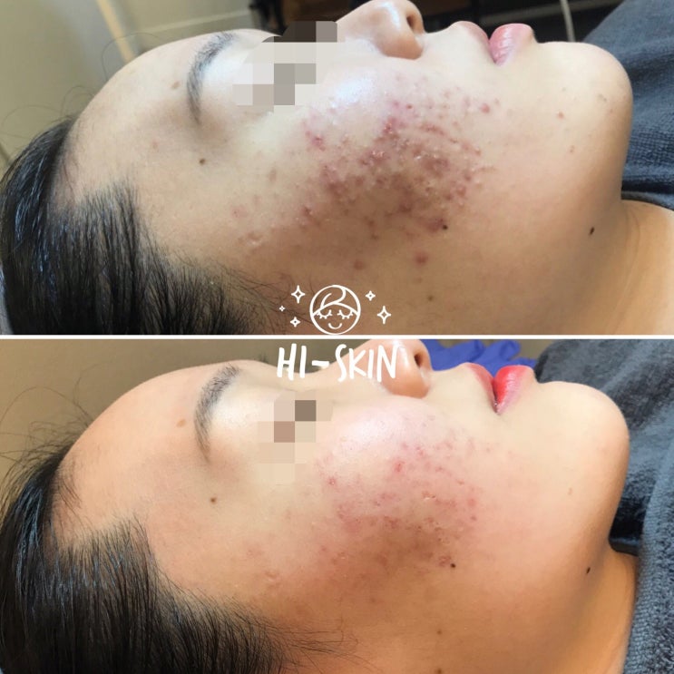  여드름압출잘하는곳 여드름전문관리실 구로디지털단지피부관리실 하이스킨