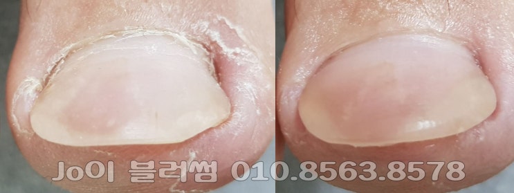  군대 다녀온 후 생긴 남자들의 고민 발톱무좀, 무좀발톱, 파고드는발톱, 염증 관리 용인, 광교, 수지 네일샵