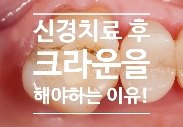 신경치료 후 크라운(보철)을 해야하는 이유