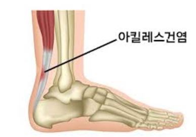 아킬레스건 파열 후 후유증이 지속된다면 "이것"을 체크하세요! 8