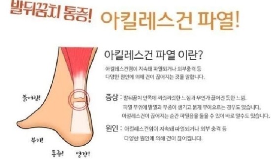 아킬레스건 파열 후 후유증이 지속된다면 "이것"을 체크하세요! 9