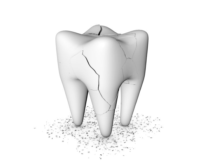 예기치 못한 치아손상 대처방법
