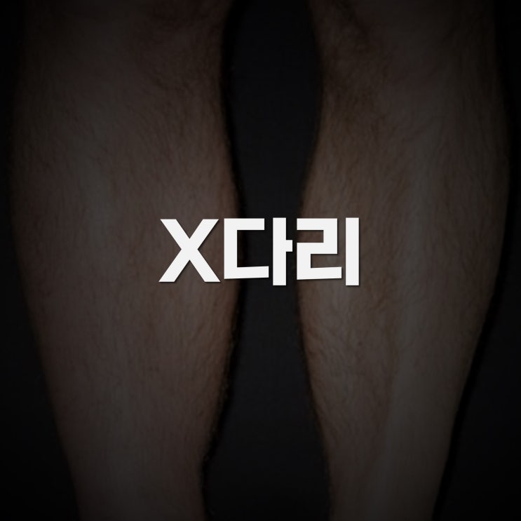  휜다리가 있는 슬개골탈구 dislocation, 절골술 및 중첩술