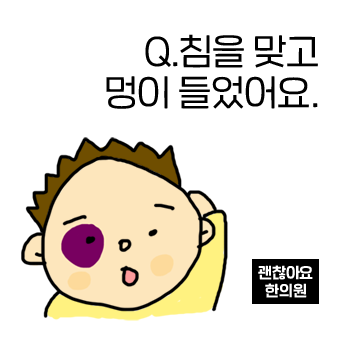 침을 맞고 멍이 들었어요. 침 부작용인가요? 침을 맞고 멍이 들었어요. 침 부작용인가요?