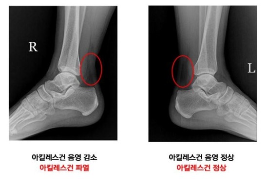 아킬레스건 파열 후 후유증이 지속된다면 "이것"을 체크하세요! 3