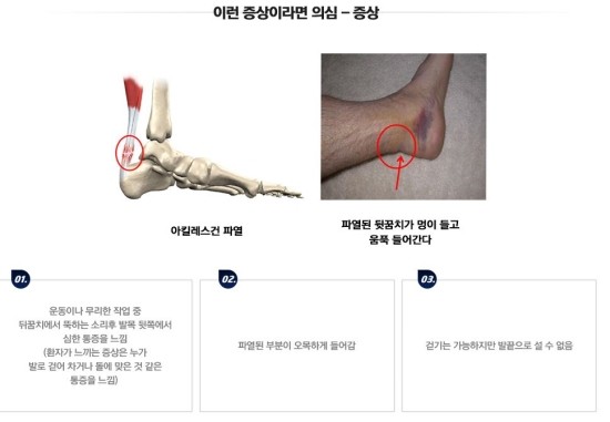 아킬레스건 파열 후 후유증이 지속된다면 "이것"을 체크하세요! 7
