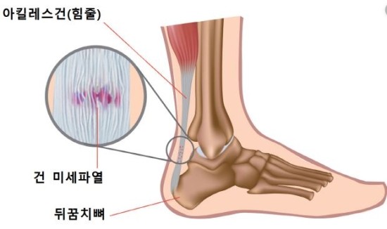 아킬레스건 파열 후 후유증이 지속된다면 "이것"을 체크하세요! 5