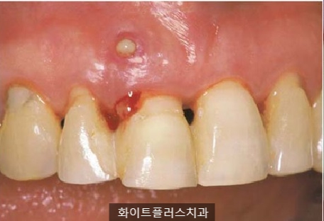 신길동 신풍역 치과 잇몸치료 비용 정리