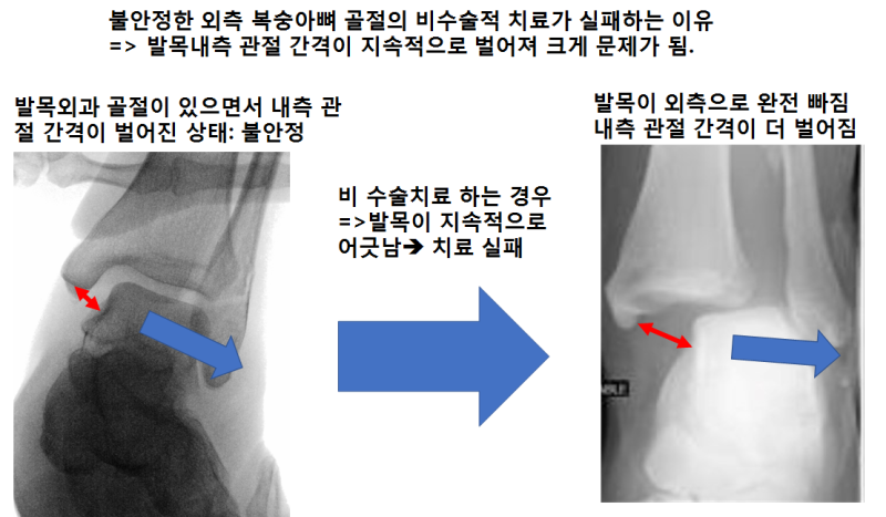 발목의 개방성 골절의 수술적 8