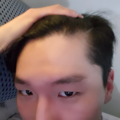  과학적으로 검증된 탈모약은 세상에 딱 2종류밖에 없다