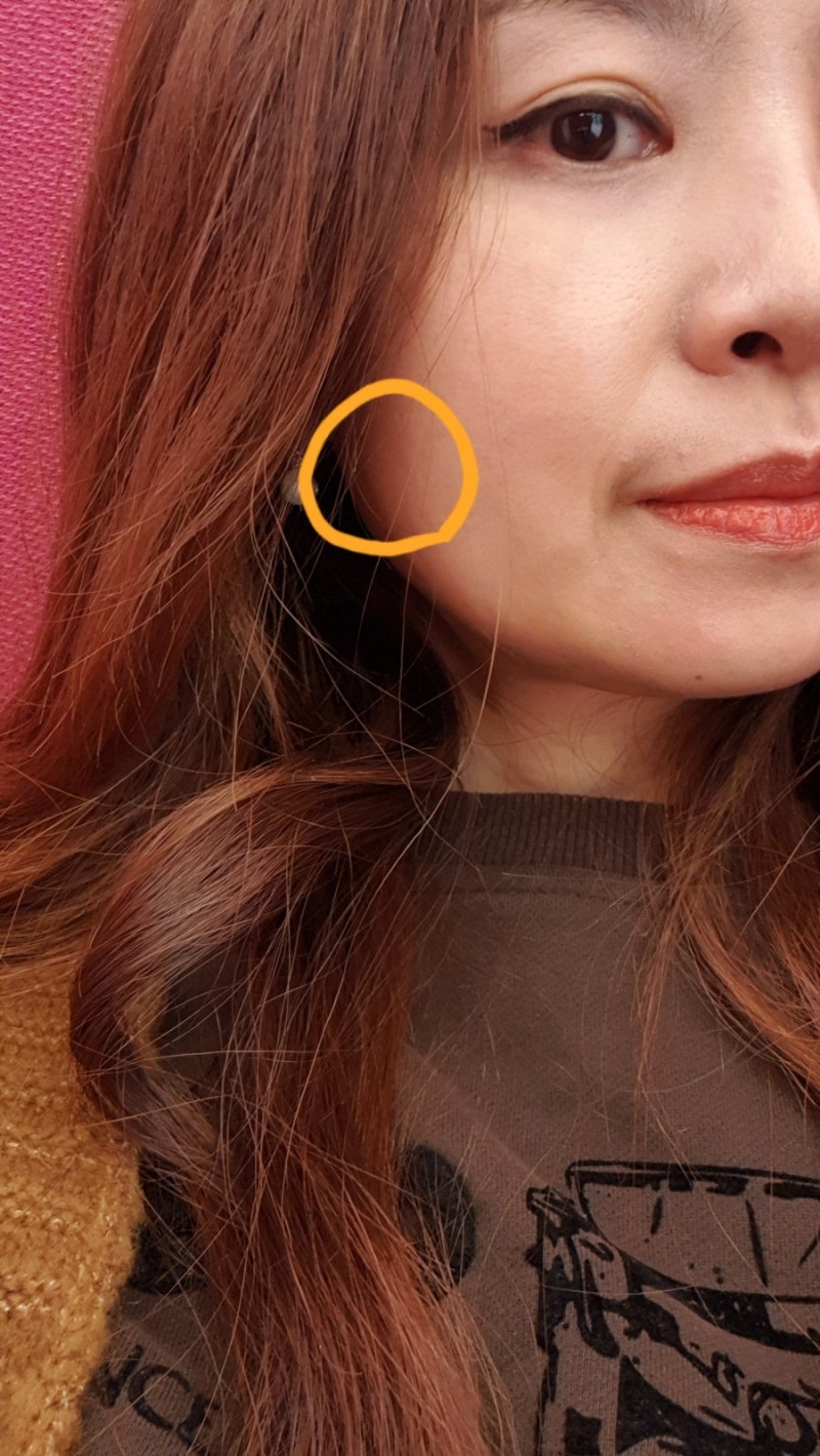 턱 근육통, 턱 보톡스 시술 2020년 1월