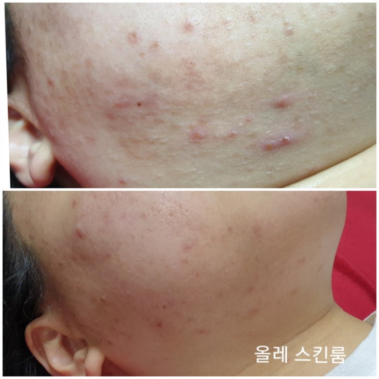  여드름 피부, 문제성 피부 개선 후기 <올레스킨룸_천안 피부관리>