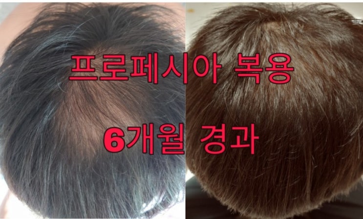  원형 탈모 프로페시아 6개월 복용 후기 실비 보험 청구 결과