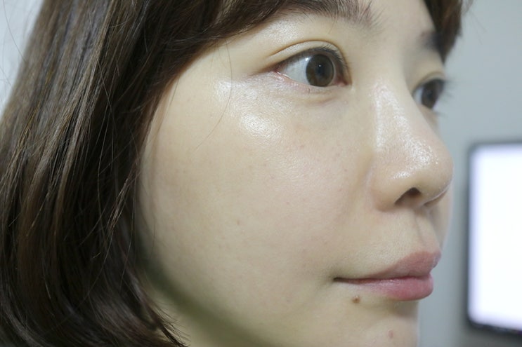  분당피부관리 30대 중반의 리쥬란힐러 후기