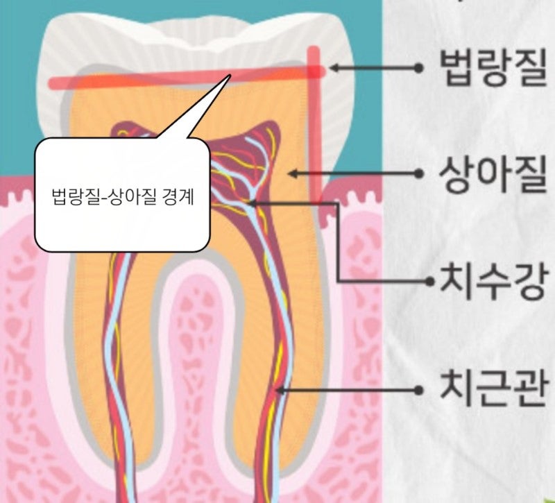 초기 충치(법랑질 충치)가 있으면 증상이 있을까요? 충치 진행 단계 정리 / 진행 속도 / 치아 신경 논문 / 시린이 시림 ...