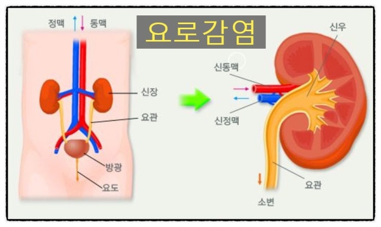  소변을 참았을때 방광암 유발위험