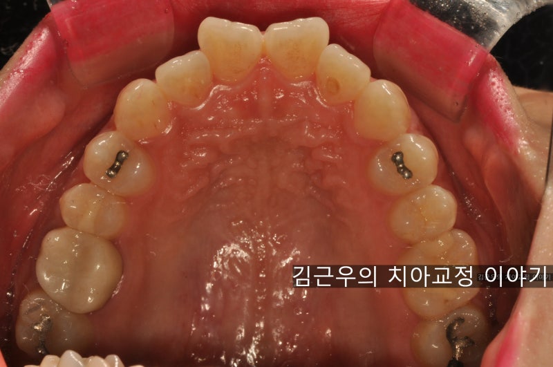 용마산역 치과 앞니 변형 교정 (나비치아)