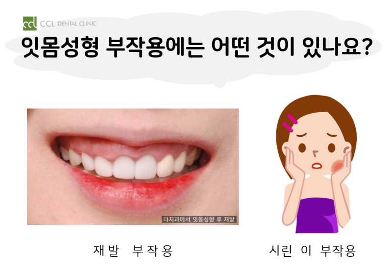 잇몸성형수술의 부작용 잇몸절단 방법 치료 수술 치과
