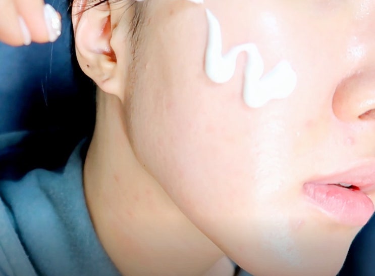  리커버리크림 한 달 사용기 안면홍조크림 이유가 있네