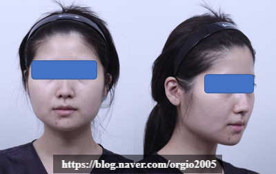  윤곽수술> 사진 전 후 비교로 보는 윤곽수술의 효과                                    (얼굴이 작아지는 것인지, 좁아지는 것인지; feat. 언어유희)