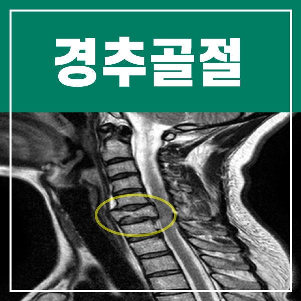 교통사고 손해사정인-교통사고 경추골절보상 무료상담 2