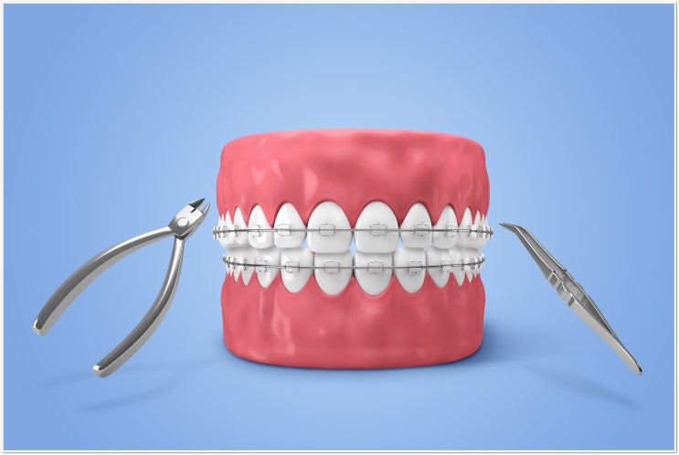 치아교정 장치 탈락 대처법, 어떻게 할까요?