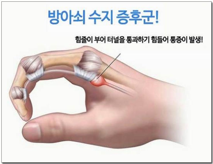 방아쇠수지증후군치료방법[손가락통증] 실제후기