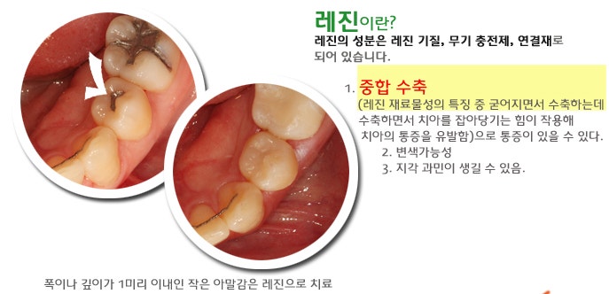 앞니 레진의 치료 방법과 치료 후 부작용이 생기는 원인은? 8