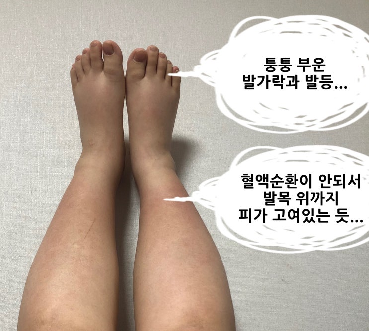  [임신 38주] 코끼리 다리, 튼살, 38주 배사진