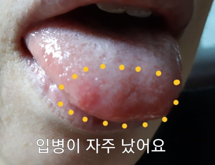  입병구내염& 혓바늘이 내 몸에서 사라진 이유