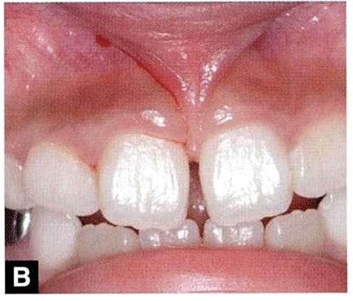 아기의 벌어진 앞니가 부끄럽나요?