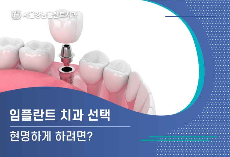  진천임플란트 현명한 선택하려면?