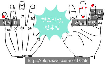 급성 편도선염,인후염 처방(사혈 등) : 네이버 블로그