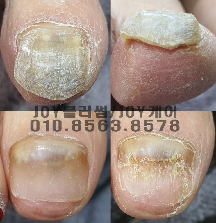  용인 나이, 남녀노소 관계없이 발톱이상, 발톱두꺼워짐, 발톱안자람, 문제성발톱을 관리해주는 네일샵 조이블러썸
