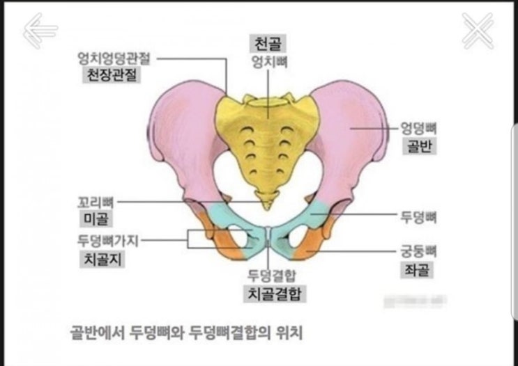 출산후 치골통 치골결합이개