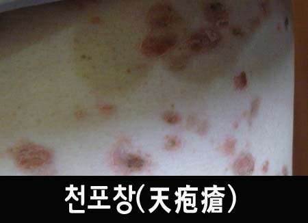 낙엽처럼 피부가 박탈이 된다 - 천포창 ①