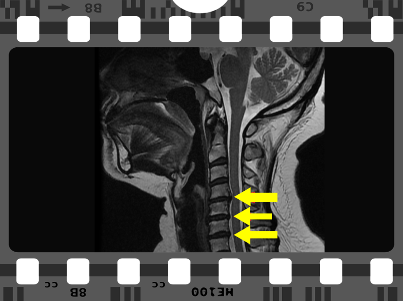 경추 5번, 6번 목디스크 파열 찢어지는 증상은 왜