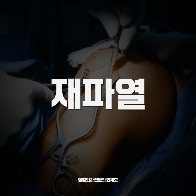  전방십자인대 재파열 rerupture로 다시 재건하기!