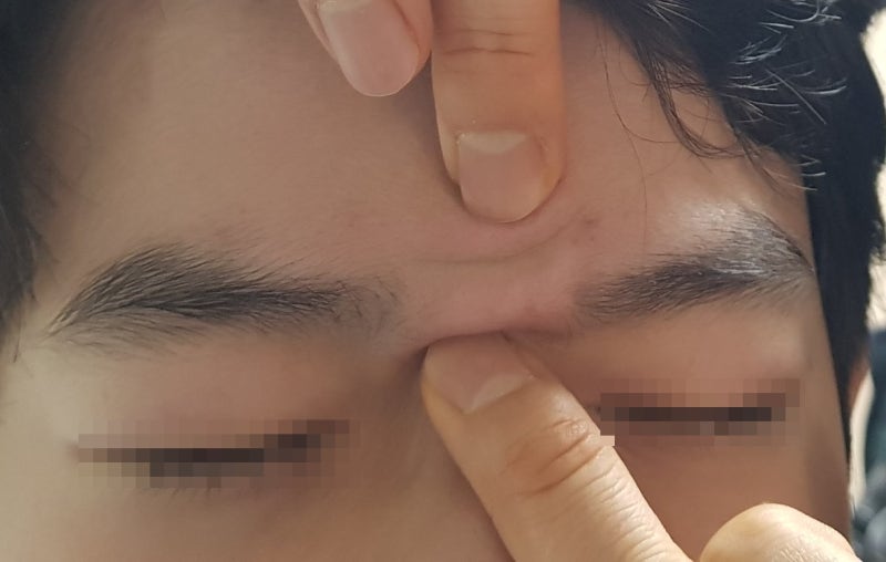 동탄미간 주름이 점점 깊어지는 것을 두려워할 때 필요한 시술 5