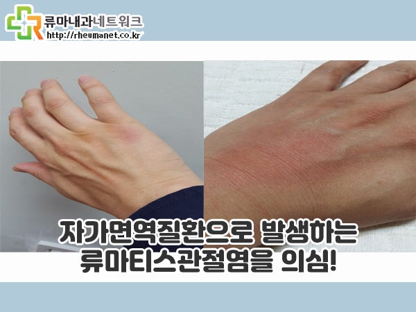 손목터널증후군 증상 류마티스내과에서 류마티스관절염 확인해보세요