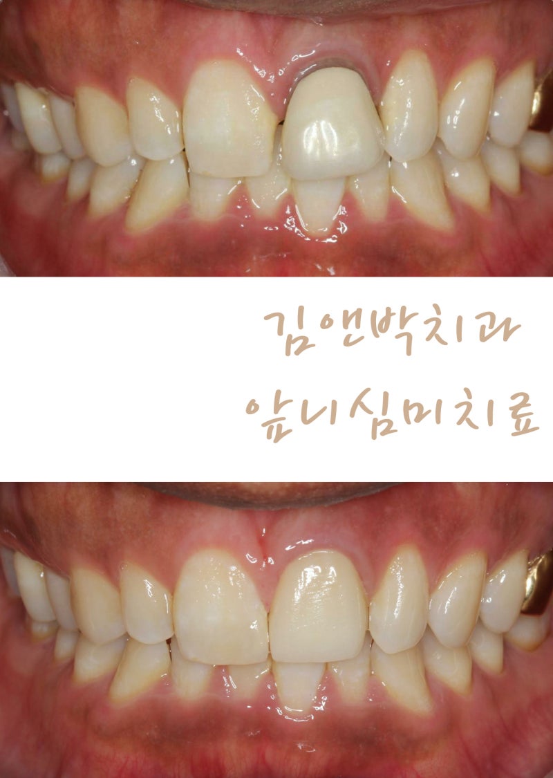 부산아픈치과<앞니크라운보철교환&흑앞니변색치실활치미백>디오스치과