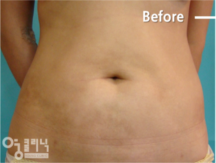 [강남지방흡입 부작용 복부지방흡입유착 강남다이어트클리닉] 이오팻주사 8