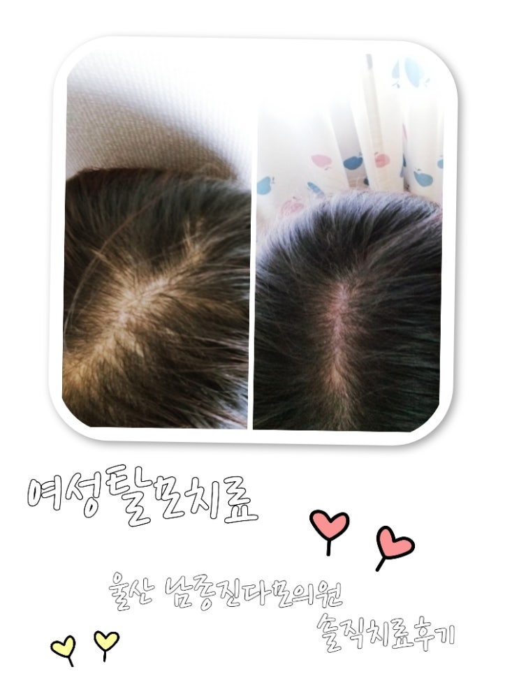  울산여자탈모치료 남종진다모의원 솔직치료후기