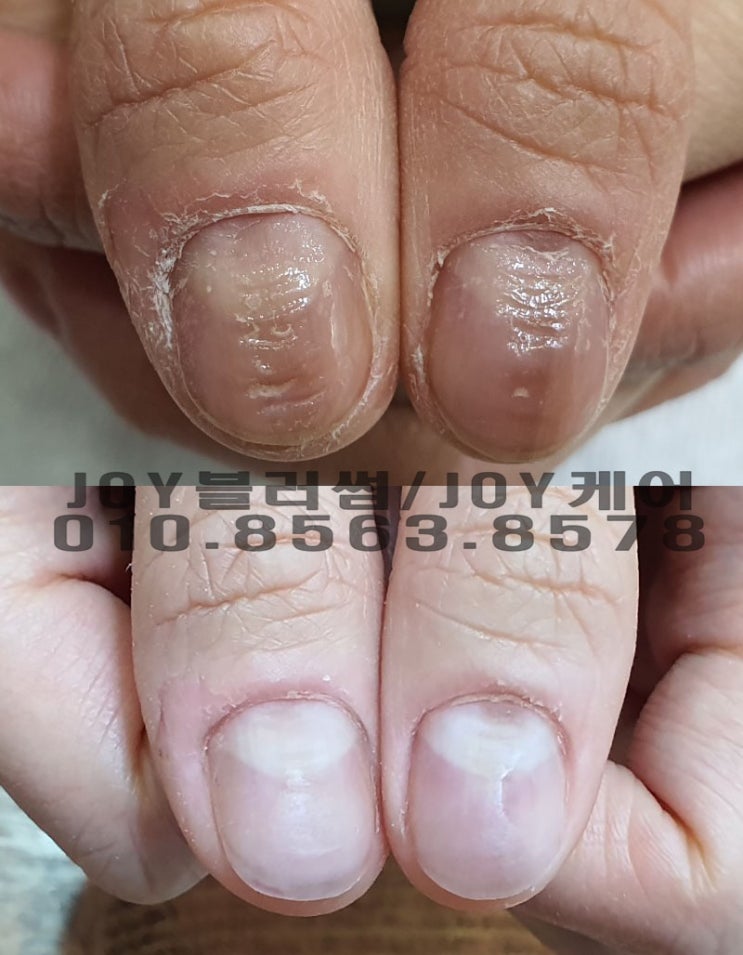  어릴 적부터 시작된 물어뜯는손톱 제대로 관리받아야 하는 이유를 느낀 고객님의 스토리 용인,광교,수지네일샵 조이블러썸