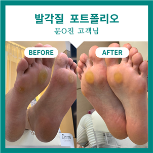 인천 부평 유해균발각질 전문맞춤케어는 페디아이티엔