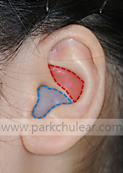 자가연골 이용한 수술하면 부작용이 많은가요? (#가슴연골, #귀연골, #코성형, #귀수술, #소이증)
