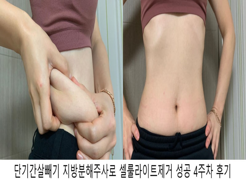 복부지방분해주사 5주 뱃살감량 도전 시작