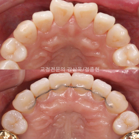 서면 정상교합치료 교정치과 정상교합을 1