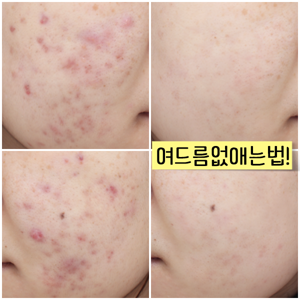  여드름 염증약에 술은 위험해~ 고생후기