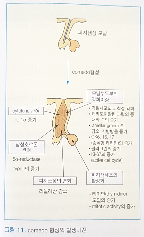 [창원여드름피부과] 좁쌀 여드름이 생기는 이유와 그 중요성?